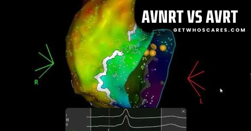 AVNRT vs AVRT